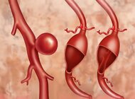 Sztuczna inteligencja zwiększa szanse na wczesne wykrycie tętniaków mózgu