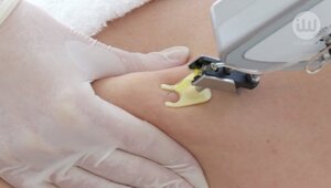 Zwalcz cellulit jeszcze przed sylwestrem