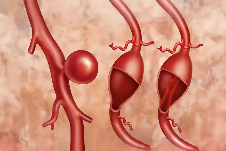 Sztuczna inteligencja zwiększa szanse na wczesne wykrycie tętniaków mózgu