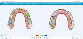 Occlusogram in IOSIM Pro.png