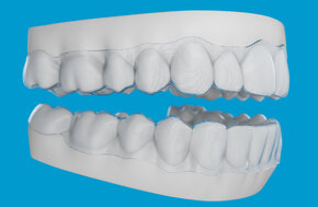 Invisalign® clear aligner custom trimline option.jpg