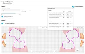 Invisalign® Palatal Expander visualization.jpg