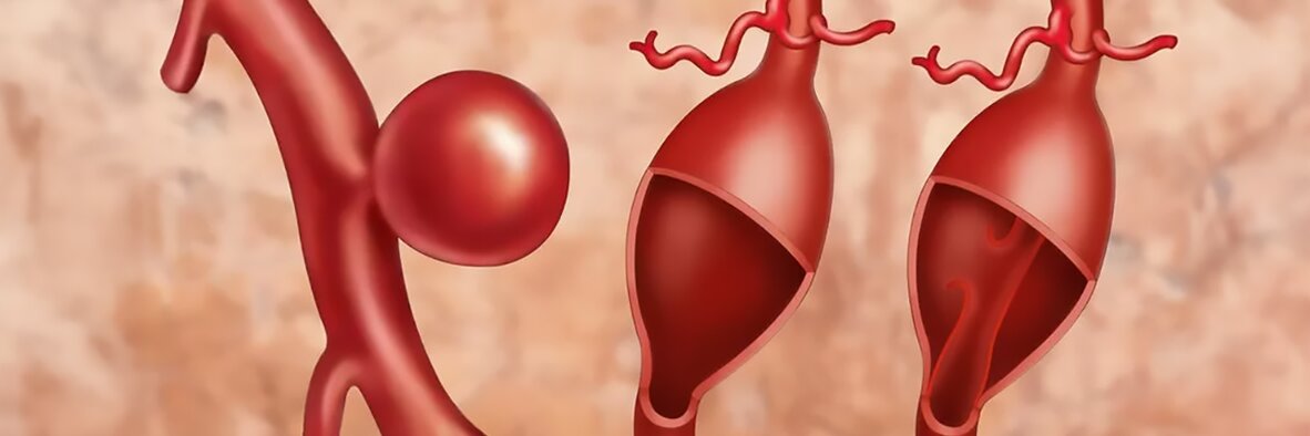 tętniak mózgu slajder