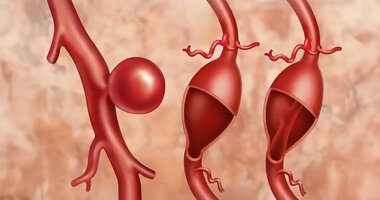 tętniak mózgu slajder